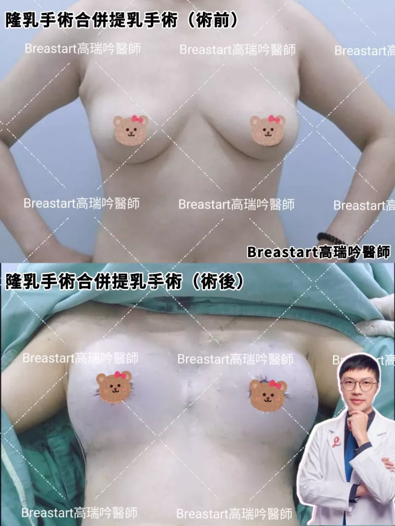 提乳手術案例