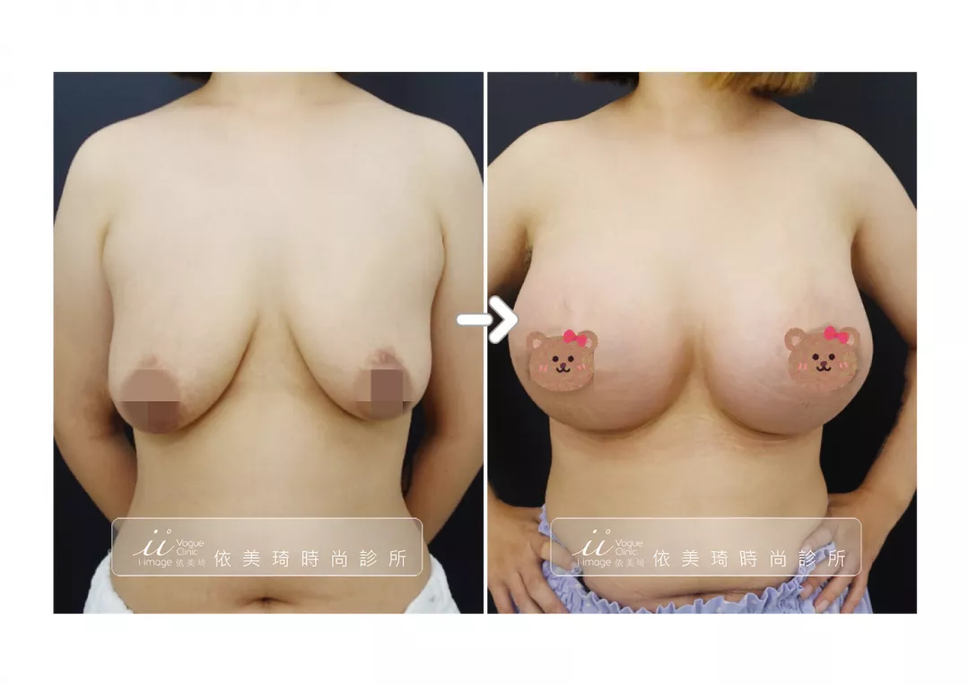 隆乳＋提乳手術案例照
