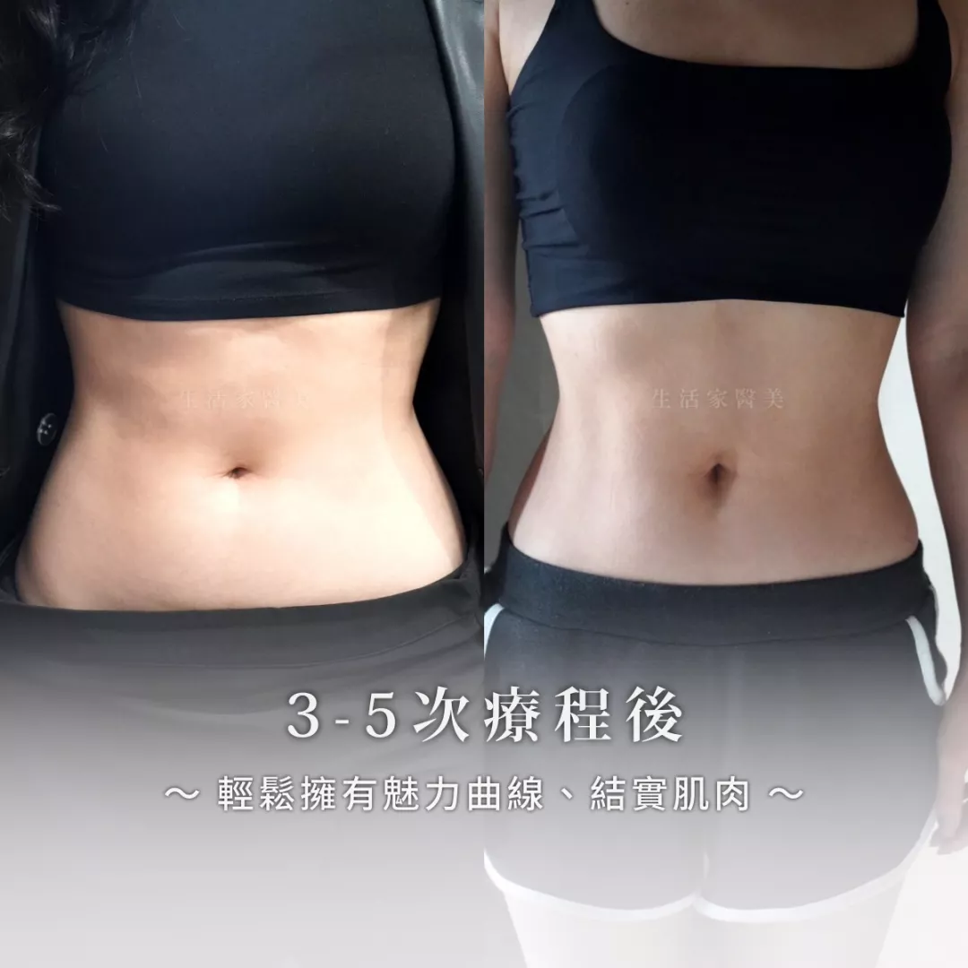 💪🏻增肌減脂 Talent Pro力美肌塑力美肌塑 Embody Emsculpt 1293